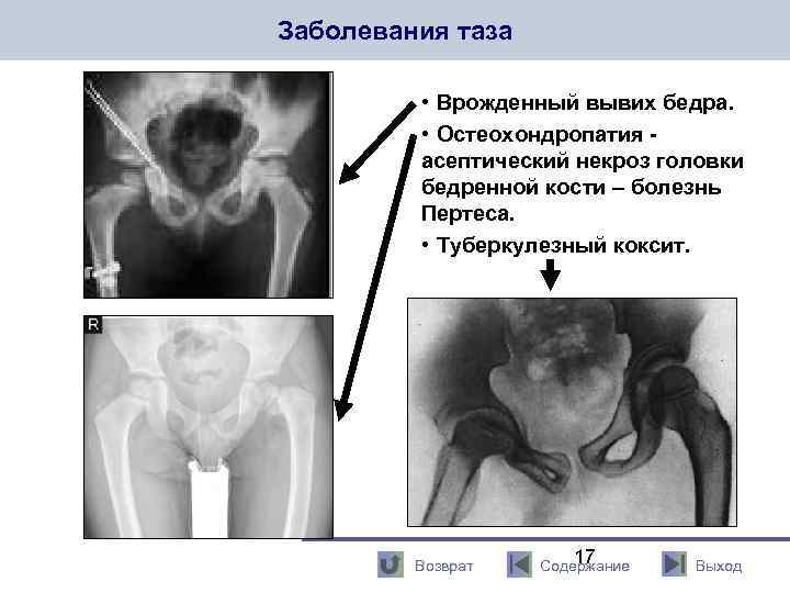 Заболевания таза