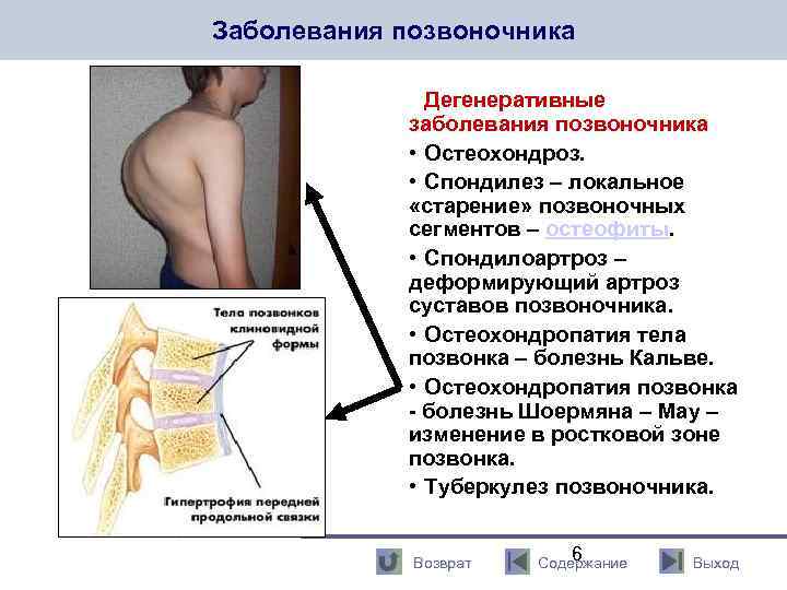 Заболевания позвоночника Дегенеративные заболевания позвоночника • Остеохондроз. • Спондилез – локальное «старение» позвоночных сегментов