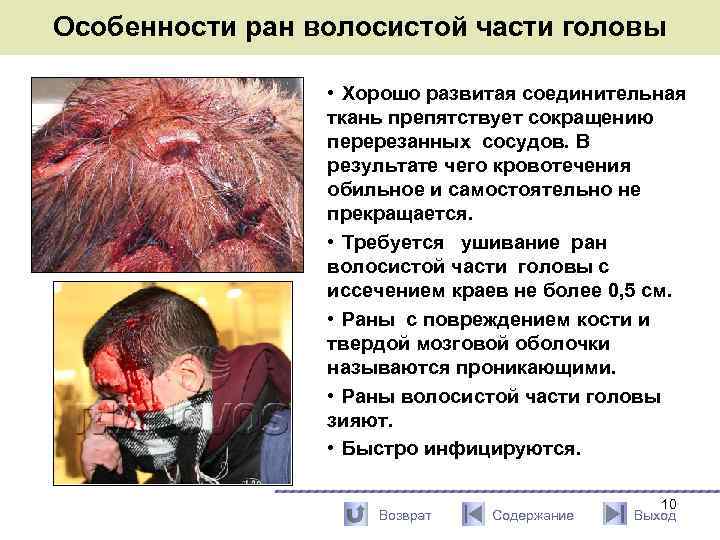Особенности ран волосистой части головы • Хорошо развитая соединительная ткань препятствует сокращению перерезанных сосудов.
