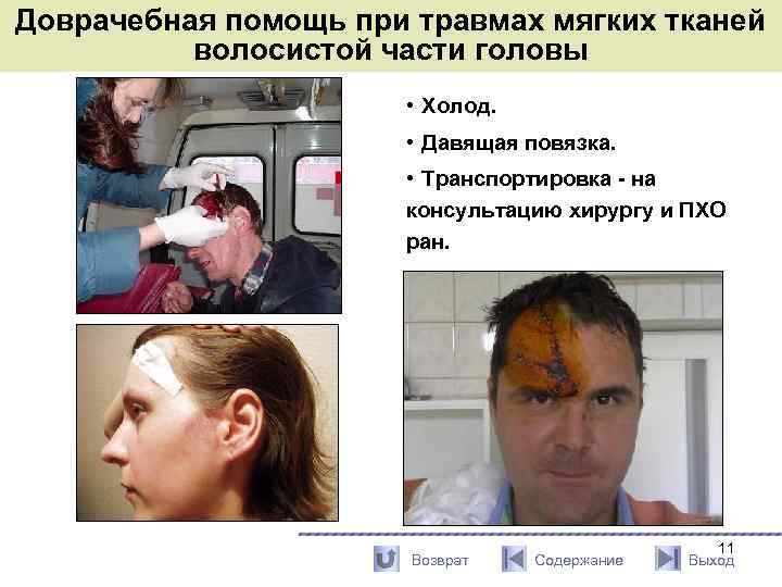 Доврачебная помощь при травмах мягких тканей волосистой части головы • Холод. • Давящая повязка.