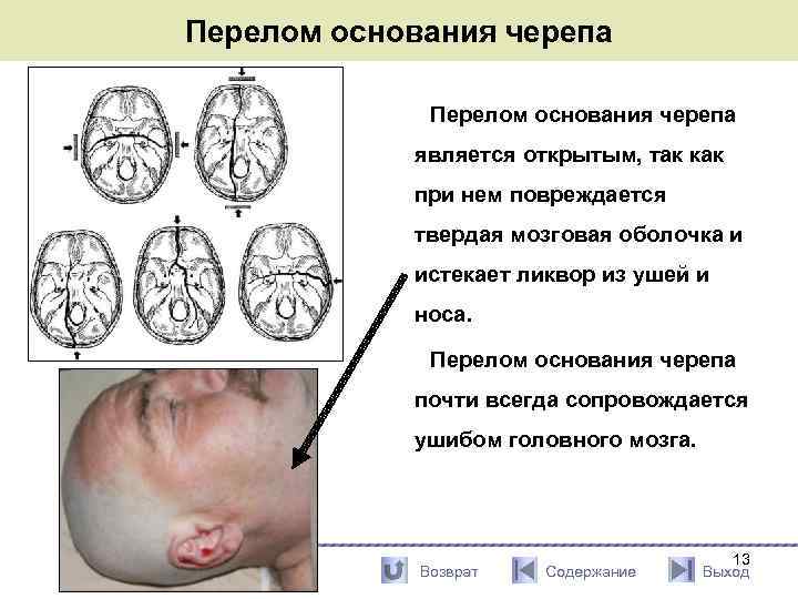 Перелом основания черепа является открытым, так как при нем повреждается твердая мозговая оболочка и