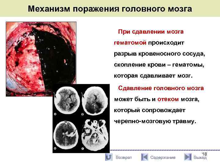 Механизм поражения головного мозга При сдавлении мозга гематомой происходит разрыв кровеносного сосуда, скопление крови