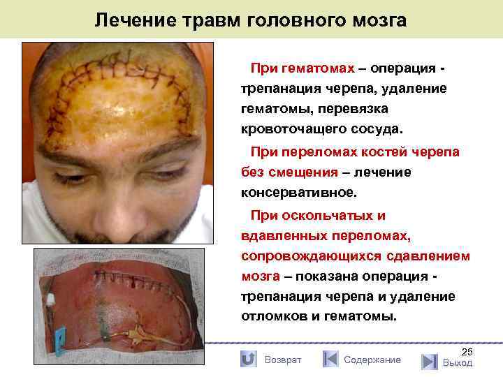 Лечение травм головного мозга При гематомах – операция - трепанация черепа, удаление гематомы, перевязка