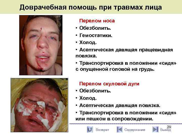 Доврачебная помощь при травмах лица Перелом носа • Обезболить. • Гемостатики. • Холод. •