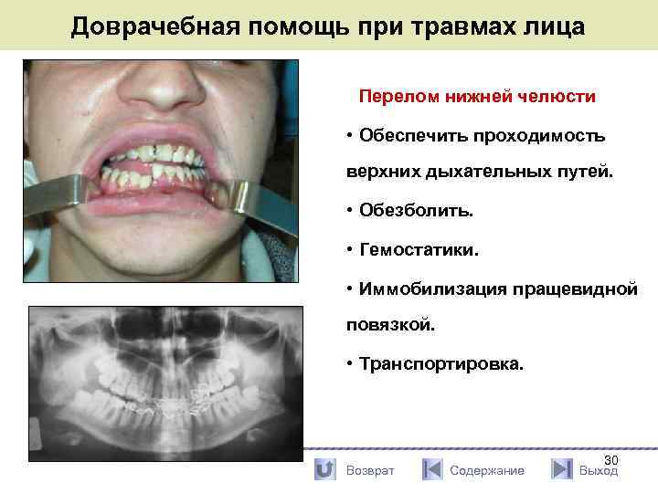 Доврачебная помощь при травмах лица Перелом нижней челюсти • Обеспечить проходимость верхних дыхательных путей.