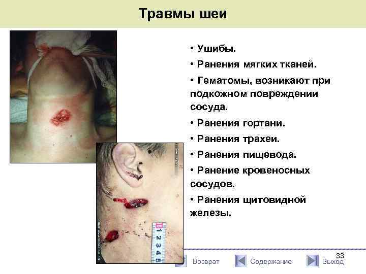 Травмы шеи • Ушибы. • Ранения мягких тканей. • Гематомы, возникают при подкожном повреждении