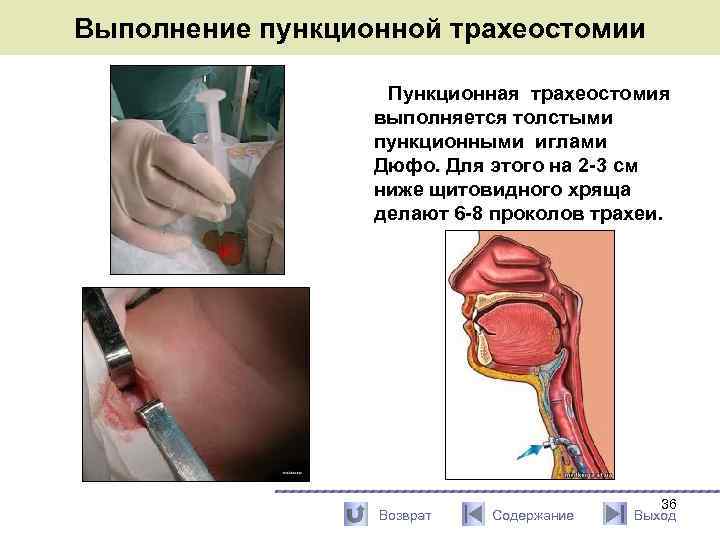 Выполнение пункционной трахеостомии Пункционная трахеостомия выполняется толстыми пункционными иглами Дюфо. Для этого на 2