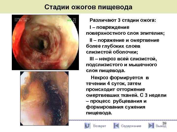 Стадии ожогов пищевода Различают 3 стадии ожога: I – повреждение поверхностного слоя эпителия; II