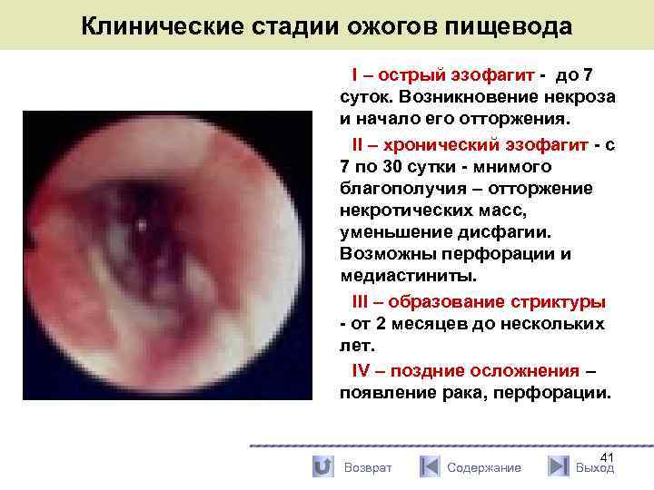 Клинические стадии ожогов пищевода I – острый эзофагит - до 7 суток. Возникновение некроза