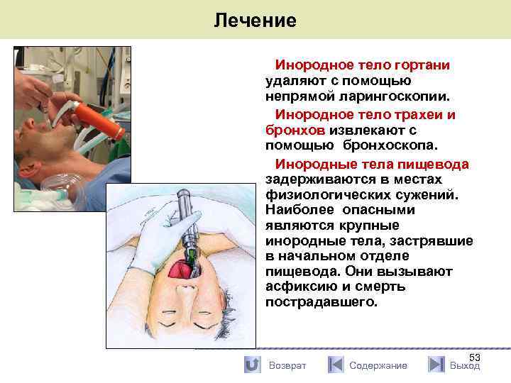 Лечение Инородное тело гортани удаляют с помощью непрямой ларингоскопии. Инородное тело трахеи и бронхов