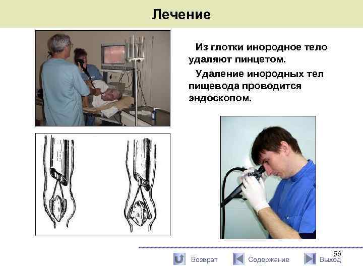 Инородное тело пищевода карта вызова скорой медицинской помощи