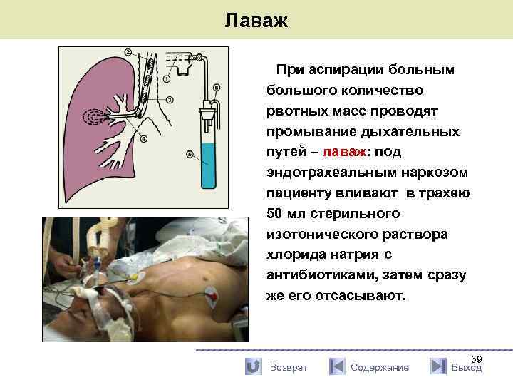 Лаваж При аспирации больным большого количество рвотных масс проводят промывание дыхательных путей – лаваж: