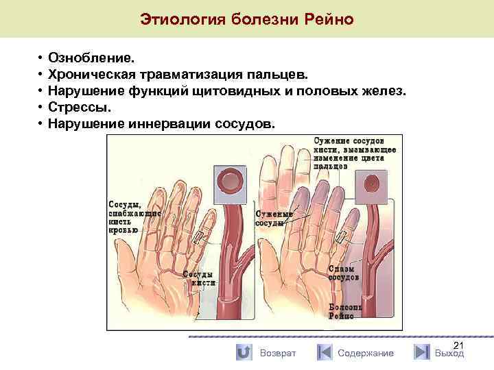 Этиология болезни Рейно • • • Ознобление. Хроническая травматизация пальцев. Нарушение функций щитовидных и