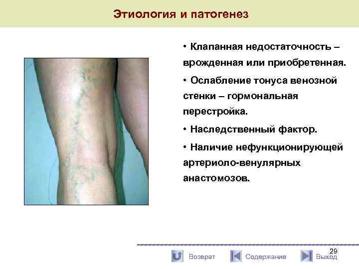  Этиология и патогенез • Клапанная недостаточность – врожденная или приобретенная. • Ослабление тонуса