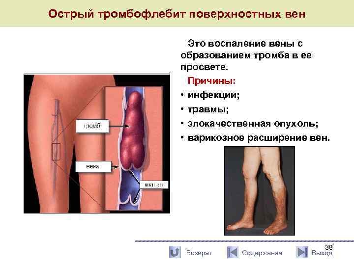 Острый тромбофлебит поверхностных вен Это воспаление вены с образованием тромба в ее просвете. Причины: