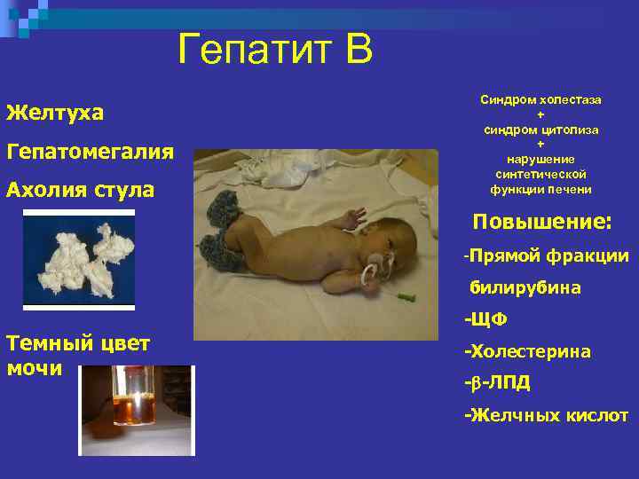 Гепатит В Желтуха Гепатомегалия Ахолия стула Синдром холестаза + синдром цитолиза + нарушение синтетической
