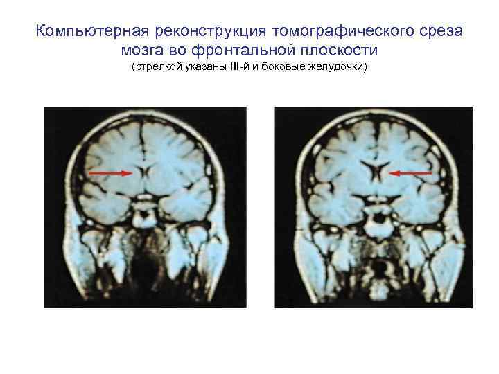 Компьютерная реконструкция томографического среза мозга во фронтальной плоскости (стрелкой указаны III-й и боковые желудочки)