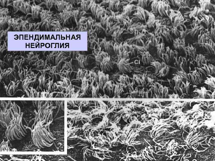 ЭПЕНДИМАЛЬНАЯ НЕЙРОГЛИЯ 