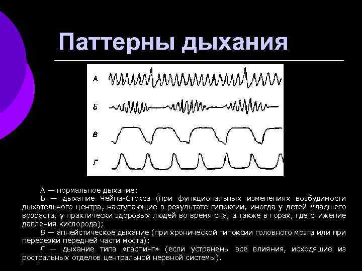 Паттерны дыхания А — нормальное дыхание; Б — дыхание Чейна-Стокса (при функциональных изменениях возбудимости