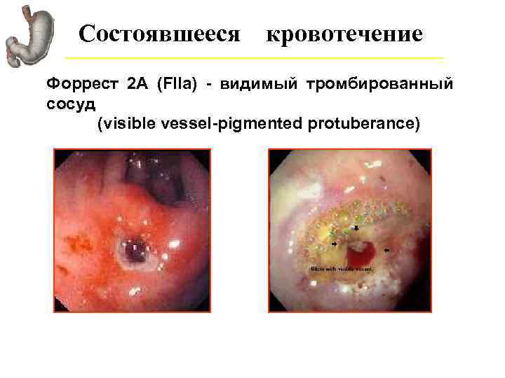 Состоявшееся кровотечение Форрест 2 А (FIIa) - видимый тромбированный сосуд (visible vessel-pigmented protuberance) 
