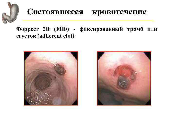 Состоявшееся кровотечение Форрест 2 В (FIIb) - фиксированный тромб или сгусток (adherent clot) 