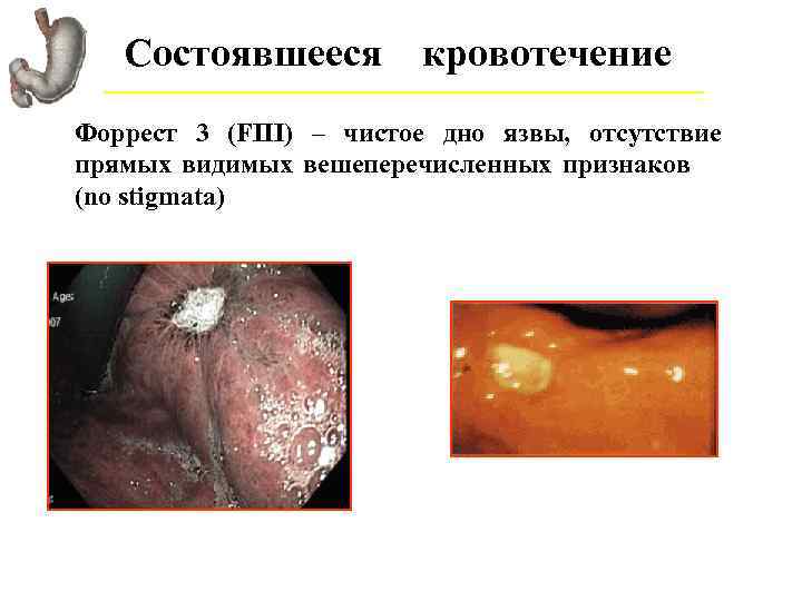 Состоявшееся кровотечение Форрест 3 (FIII) – чистое дно язвы, отсутствие прямых видимых вешеперечисленных признаков