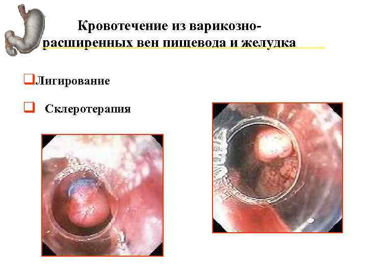 Кровотечение из варикознорасширенных вен пищевода и желудка q. Лигирование q Склеротерапия 