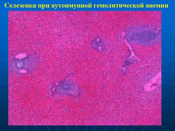 Цвет селезенки. Гемохроматоз гистология. Селезенка при гемолитической анемии микропрепарат. Селезенка при гемолитической анемии микропрепарат патанатомия. Малярийная пигментация печени микропрепарат.