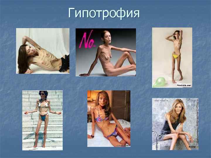 Гипотрофия 