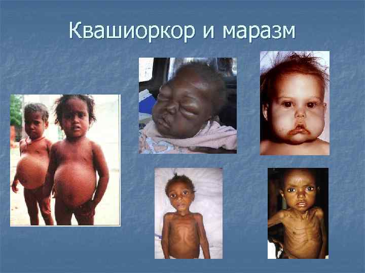 Квашиоркор и маразм 