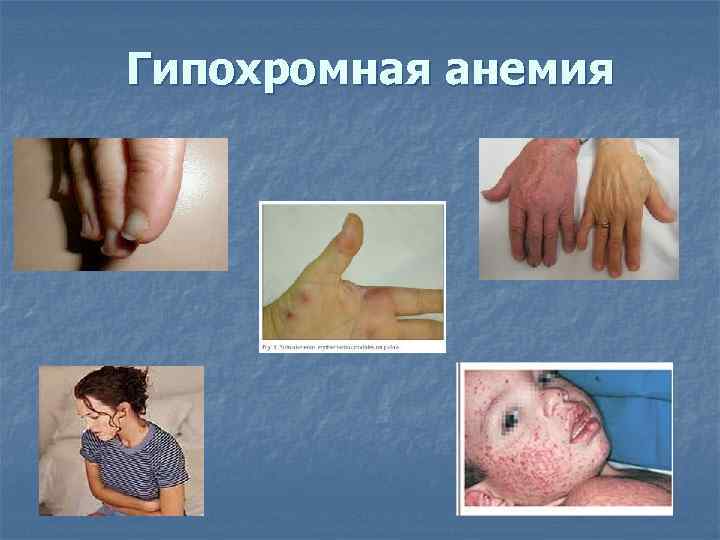 Гипохромная анемия 