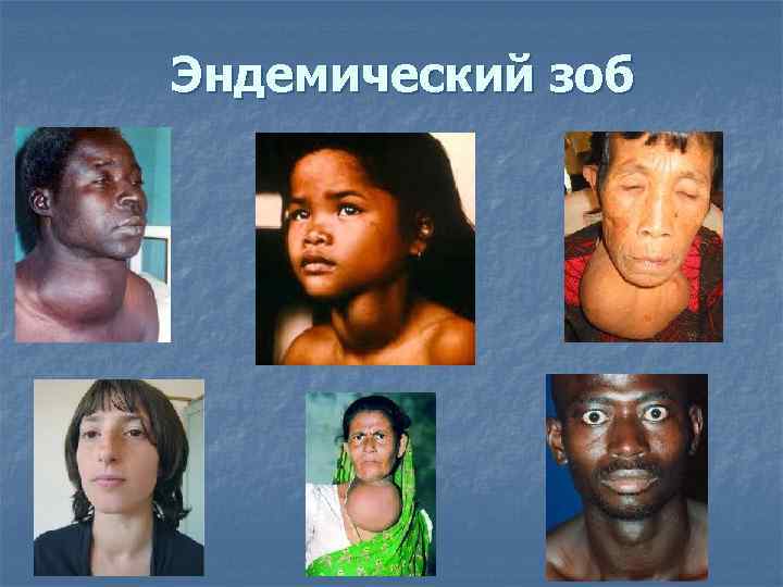 Эндемический зоб 