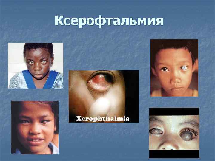 Ксерофтальмия 
