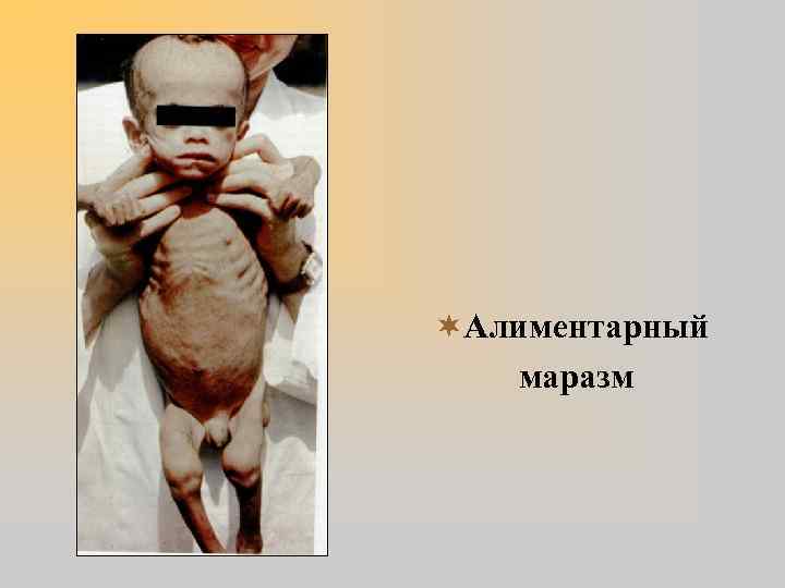 ¬Алиментарный маразм 