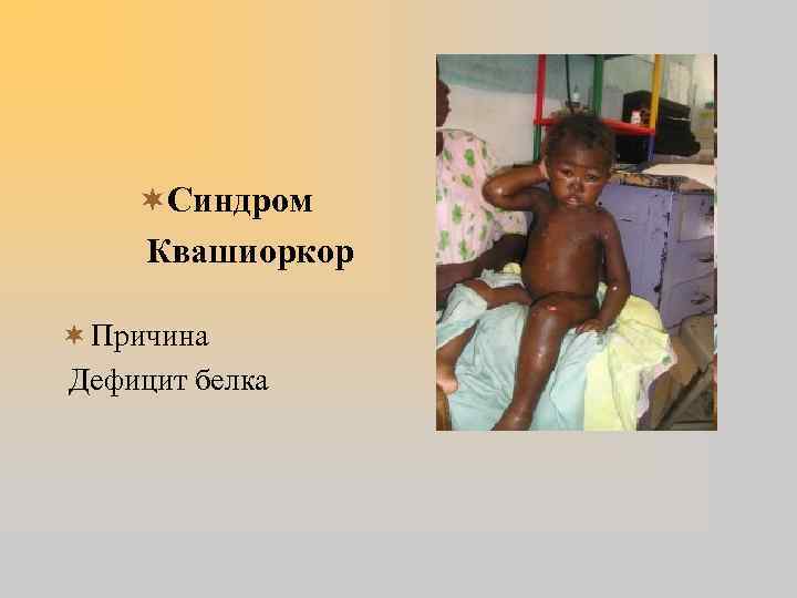 ¬Синдром Квашиоркор ¬ Причина Дефицит белка 