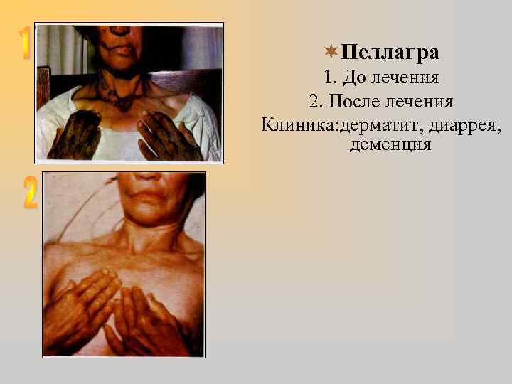 ¬Пеллагра 1. До лечения 2. После лечения Клиника: дерматит, диаррея, деменция 