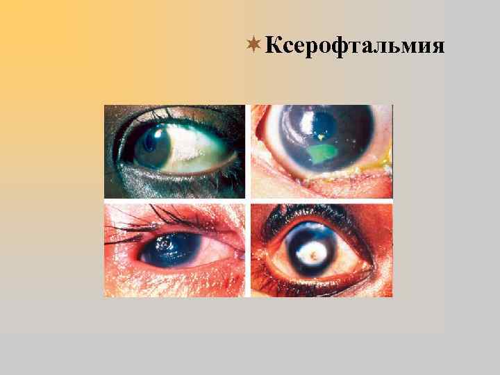¬Ксерофтальмия 