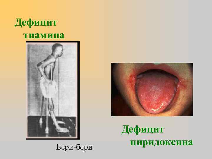 Дефицит тиамина Бери-бери Дефицит пиридоксина 