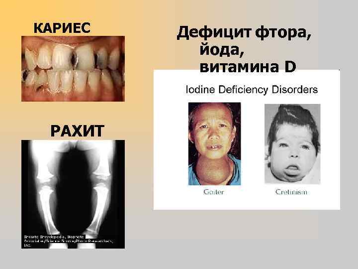 КАРИЕС РАХИТ Дефицит фтора, йода, витамина D 