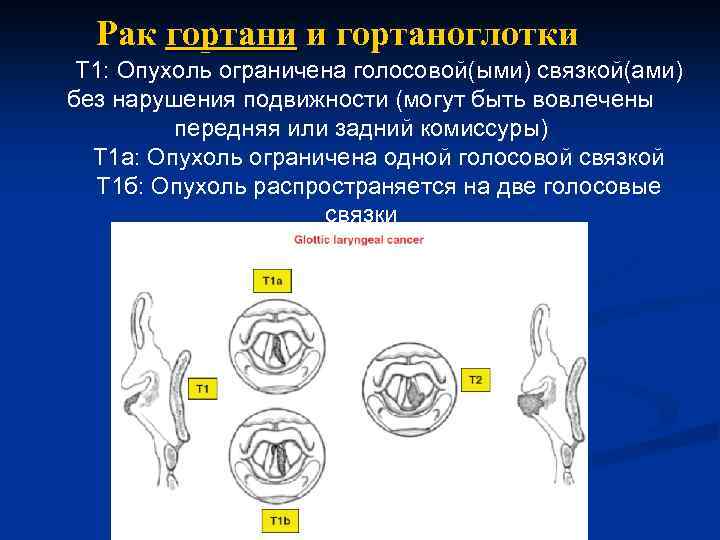 Рак гортани и гортаноглотки Т 1: Опухоль ограничена голосовой(ыми) связкой(ами) без нарушения подвижности (могут