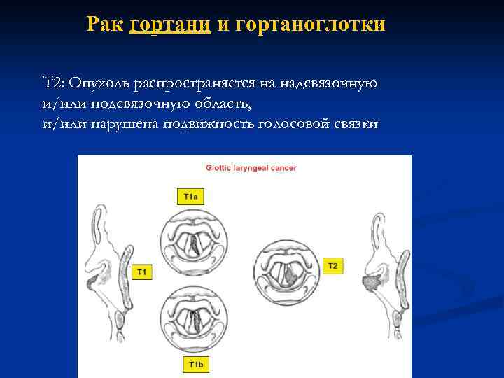 Рак гортани и гортаноглотки Т 2: Опухоль распространяется на надсвязочную и/или подсвязочную область, и/или