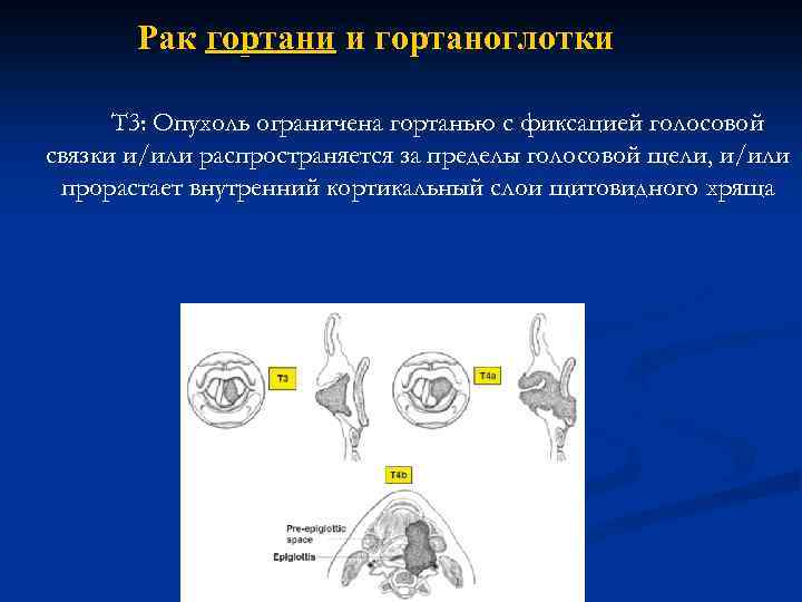 Рак гортани и гортаноглотки Т 3: Опухоль ограничена гортанью с фиксацией голосовой связки и/или