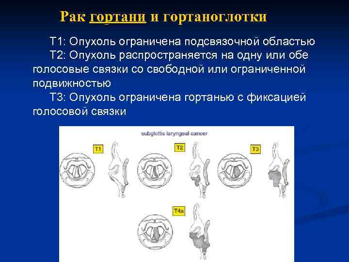 Рак гортани и гортаноглотки Т 1: Опухоль ограничена подсвязочной областью Т 2: Опухоль распространяется