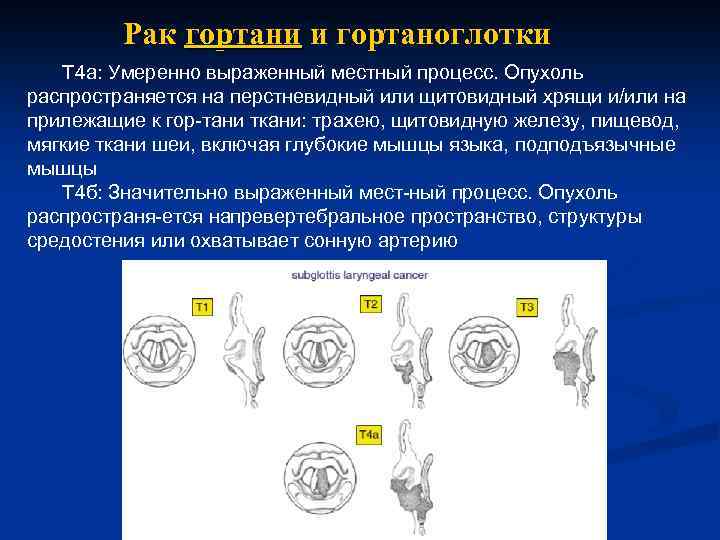 Рак гортани и гортаноглотки Т 4 а: Умеренно выраженный местный процесс. Опухоль распространяется на