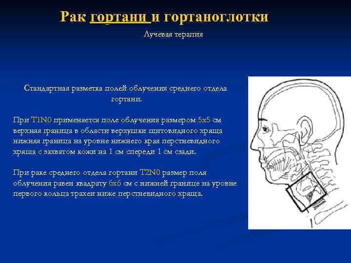 Рак гортани и гортаноглотки Лучевая терапия Стандартная разметка полей облучения среднего отдела гортани. При