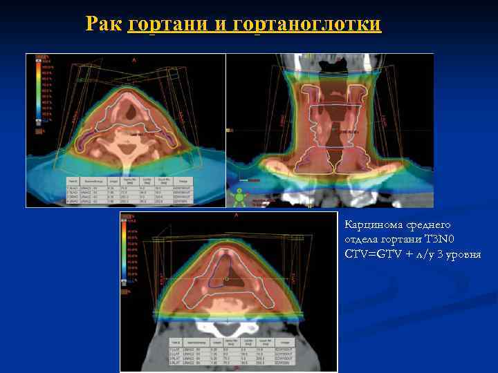 Рак гортани и гортаноглотки Карцинома среднего отдела гортани T 3 N 0 CTV=GTV +