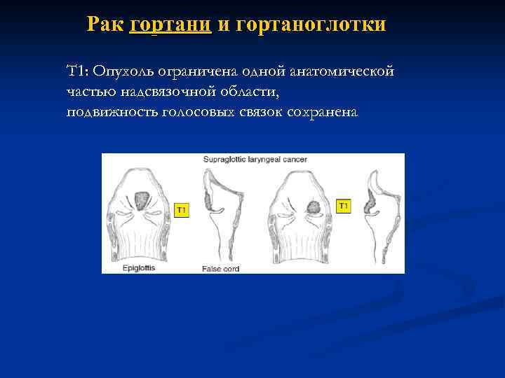 Рак гортани и гортаноглотки Т 1: Опухоль ограничена одной анатомической частью надсвязочной области, подвижность