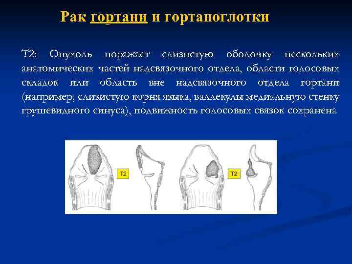 Рак гортани и гортаноглотки Т 2: Опухоль поражает слизистую оболочку нескольких анатомических частей надсвязочного