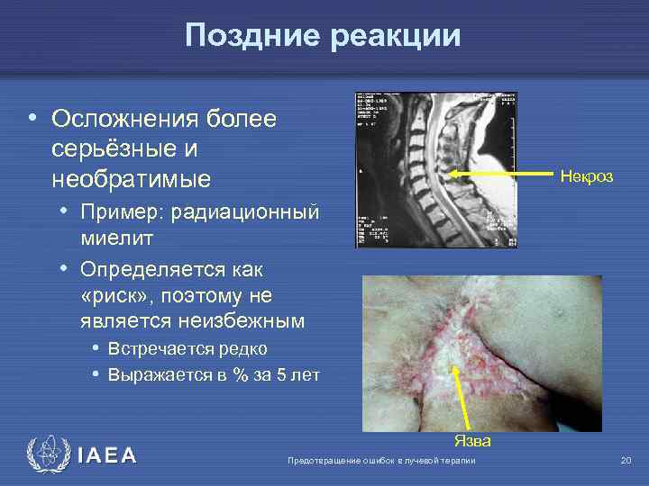 Поздние реакции • Осложнения более серьёзные и необратимые • Пример: радиационный Некроз миелит •