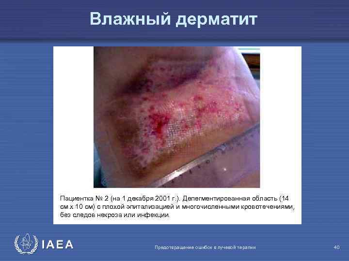 Влажный дерматит Пациентка № 2 (на 1 декабря 2001 г. ). Депегментированная область (14